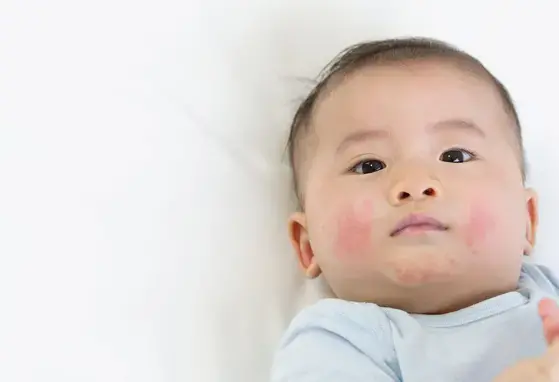 Chẩn đoán và điều trị dị ứng đạm sữa bò (publications) Chẩn đoán và điều trị dị ứng đạm sữa bò (publications)